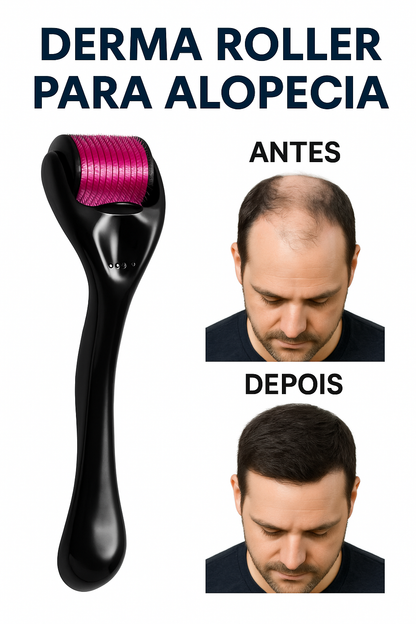 Derma Roller 540 Agulhas – Combate Eficaz à Alopecia